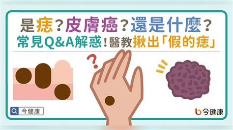 腋下長痣|是痣？皮膚癌？還是什麼？常見Q&A解惑！醫教揪出「。